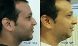 קו לסת לפני ואחרי - גבר צעיר