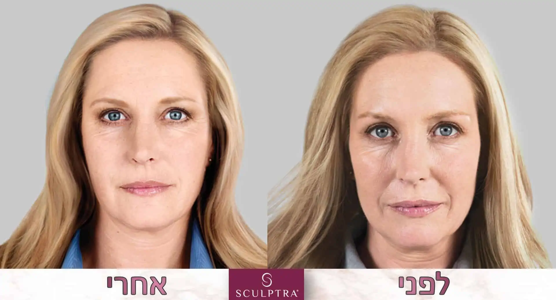 סקולפטרה - טיפול יעיל במיוחד