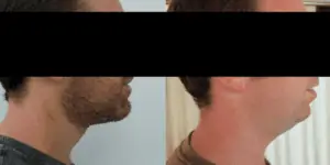 קו לסת לפני ואחרי