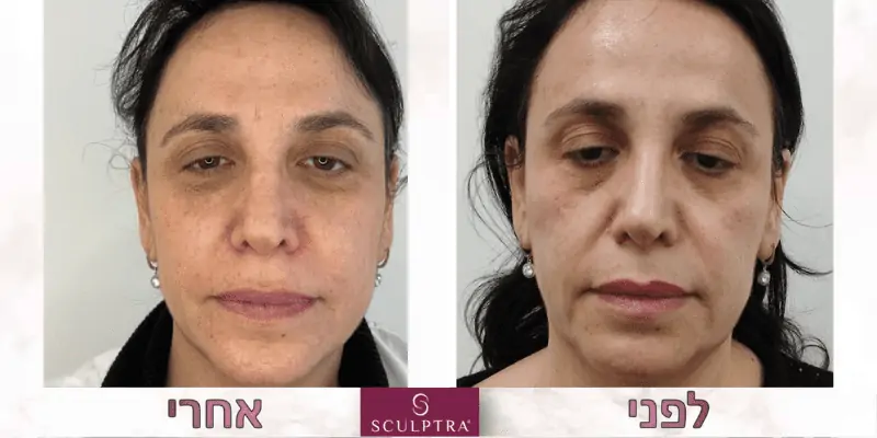 לפני אחרי - טיפול סקולפטרה