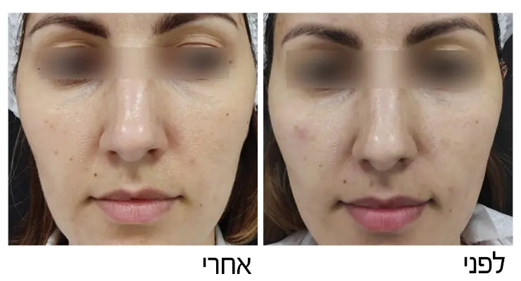 סלבוסטר Cellbooster לפני ואחרי